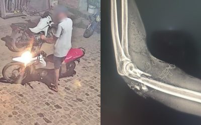 1 de 1 Suspeito do crime (à esq.) e raio-X do braço da vítima (à dir.)