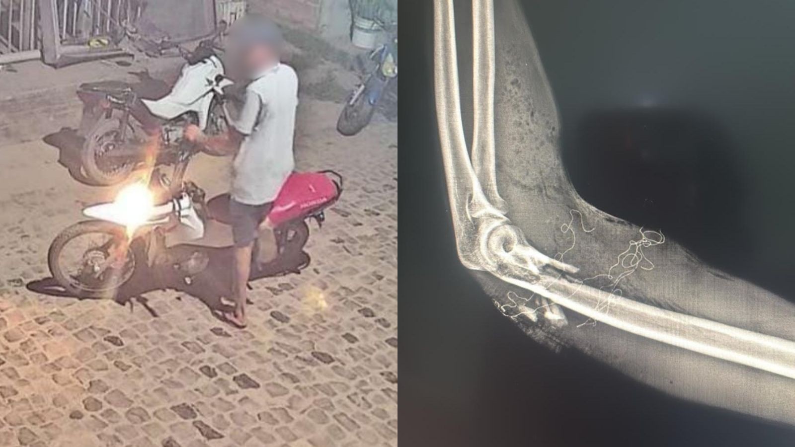 1 de 1 Suspeito do crime (à esq.) e raio-X do braço da vítima (à dir.)