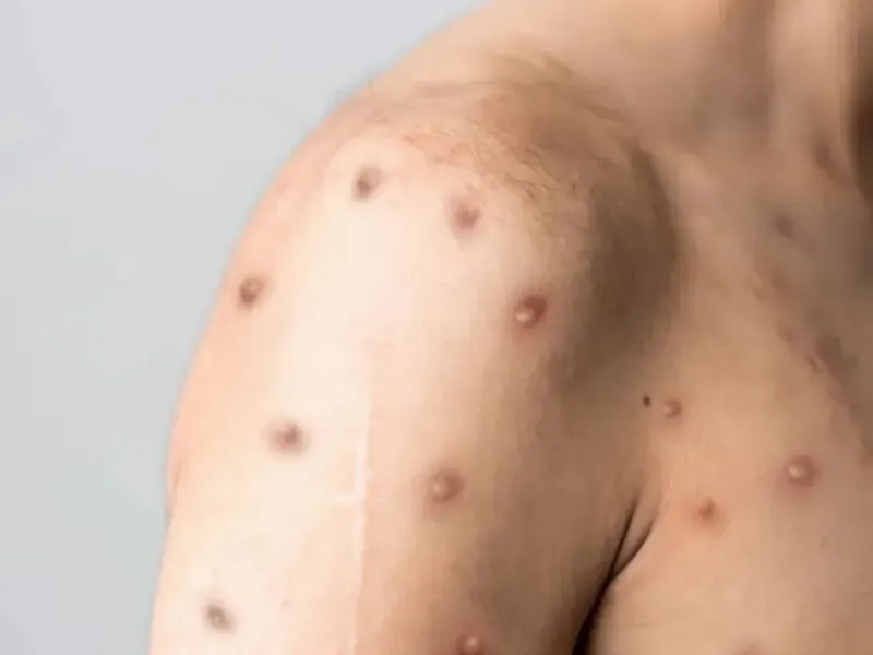 Mpox